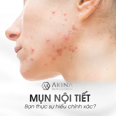 Trị mụn tại Đà Nẵng - Trị Nám - AKINA Center
